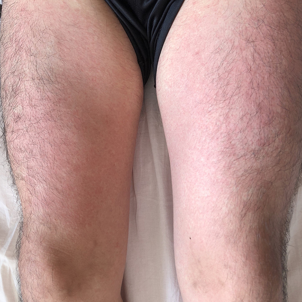A rash on the patient’s lower extremities at the time of high-grade fever.