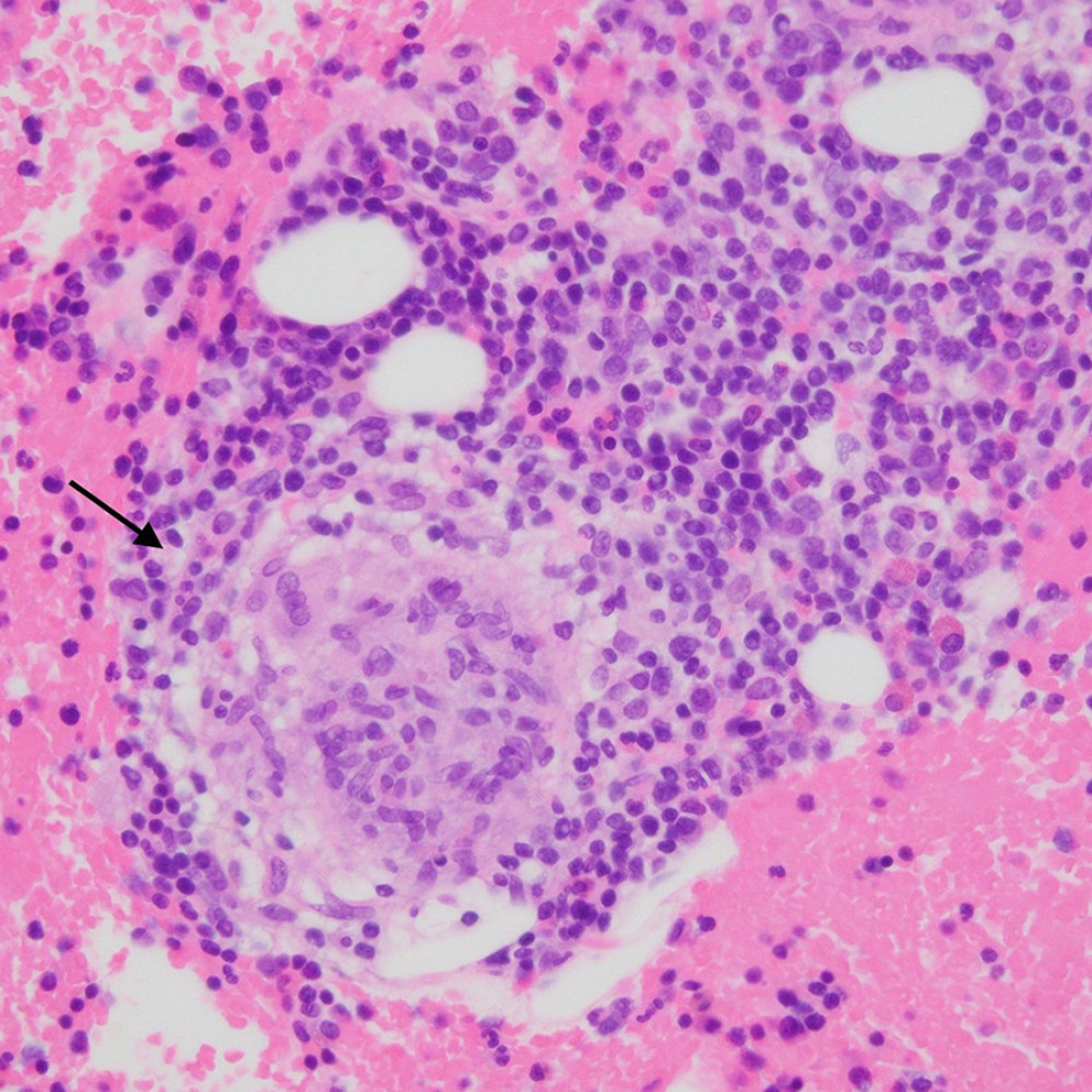 An epithelioid cell granuloma in the hematoxylin and eosin stain of bone marrow aspiration clot sample (arrow) (400×).
