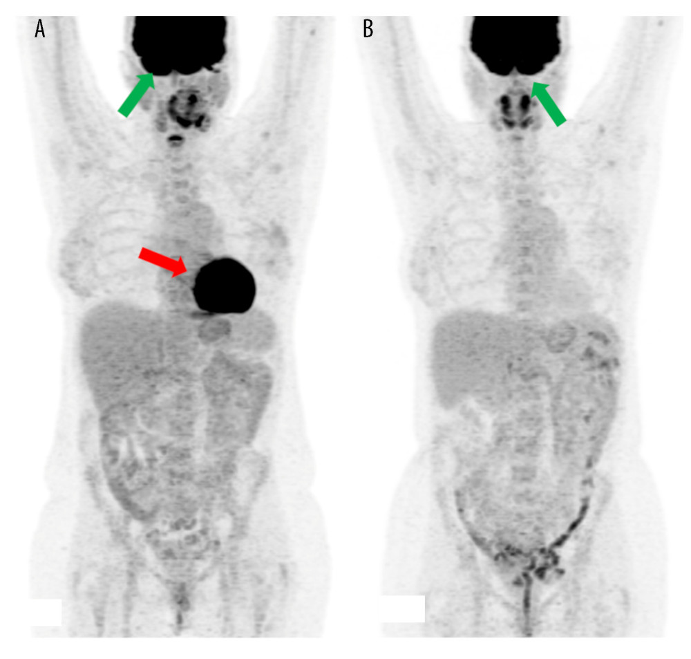 Maximum intensity projection images of 18F-fluorodeoxyglucose (18F-FDG) positron emission tomography/computed tomography (PET/CT) scans performed in June 2020 (A) and December 2020 (1B). No FDG-avid lesions suggestive of malignancy were identified in either scan. The high metabolism of the tracer in the brain (green arrows, A, B) and in the heart (red arrow, A) is physiologic. Imaging was conducted using the Advantage Workstation for Diagnostic Imaging (GE; AW4.6_05.003_SLED_11; GIMP 2.10 General Public License).