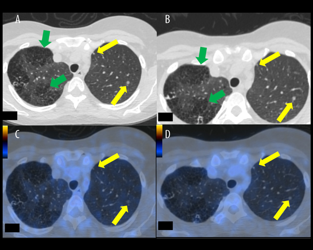 Transaxial scans of computed tomography (CT) and fused 18F-fluorodeoxyglucose (FDG) positron emission tomography/CT (PET/CT) performed in June 2020 (left column, images A, C) and in December 2020 (right column, images B, D). Yellow arrows show pulmonary nodules (with no FDG uptake). Green arrows indicate sites of lymphangioleiomyomatosis. No progression was seen between the 2 scans. Imaging was conducted using the Advantage Workstation for Diagnostic Imaging (GE; AW4.6_05.003_SLED_11; GIMP 2.10 General Public License).
