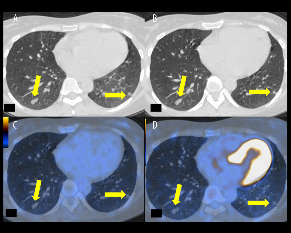 Transaxial scans of computed tomography (CT) and fused 18F-fluorodeoxyglucose (FDG) positron emission tomography/CT (PET/CT) performed in June 2020 (left column, images A, C) and in December 2020 (right column, images B, D). Yellow arrows show pulmonary nodules (with no FDG uptake). No progression was seen between the 2 scans. Imaging was conducted using the Advantage Workstation for Diagnostic Imaging (GE; AW4.6_05.003_SLED_11; GIMP 2.10 General Public License).