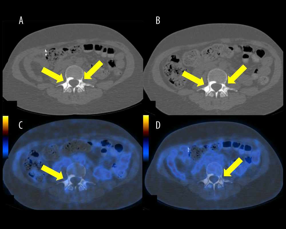 Transaxial scans of computed tomography (CT) and fused 18F-fluorodeoxyglucose (FDG) positron emission tomography/ CT (PET/CT) performed in June 2020 (left column; images A, C) and in December 2020 (right column; images B, D). Yellow arrows indicate sclerotic lesions in the body of the L3 vertebra, with no FDG uptake. The lesions did not progress in the time between the 2 scans. Imaging was conducted using the Advantage Workstation for Diagnostic Imaging (GE; AW4.6_05.003_SLED_11; GIMP 2.10 General Public License).