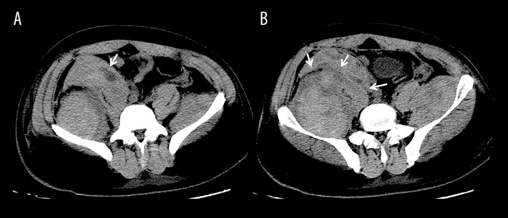 The abdominal computed tomography scan on day 9. White arrows (↓) indicate the hematomas in the bilateral psoas major and iliopsoas (A, B). On the right side, the white arrow indicates (A) the accumulation of blood in the psoas major with the mean value of 19 Hounsfield units, and (B) the fascia between psoas major and iliopsoas with thickening and swelling.