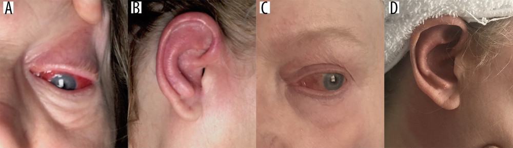 (A, B) Views of left eye and right ear pre-treatment revealing right auricular erythema and swelling in association with left scleral erythema and left eyelids swelling. (C, D) Views of left eye and right ear after treatment, revealing significant improvement of auricular and ocular erythema and swelling.