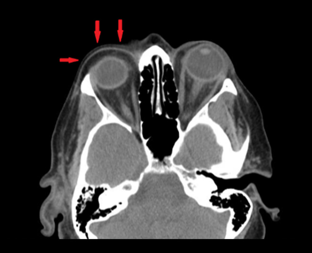 Computed tomography of facial bones and orbits, showing left periorbital soft tissue swelling with mild induration in the intra-orbital fat without mass, asymmetry of the extraocular muscles or exophthalmos, consistent with idiopathic orbital inflammation/idiopathic orbital inflammatory syndrome (IOIS).