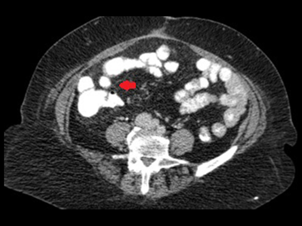 Abdominal computed tomography scan: The red arrow shows invagination of the ileum, ileocecal valve, and part of the ascending colon inside the terminal section of the ascending colon. (Image processed with MS Paint, edition 6.1, 2009, Microsoft Corporation, Redmond, Washington, USA).
