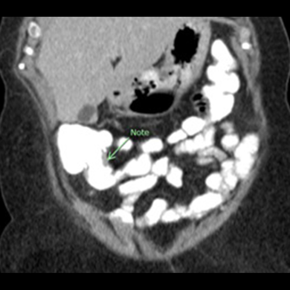 Coronal image of the abdominal computed tomography scan: The green arrow shows the parts involved in the intussusception. (Image processed with MS Paint, edition 6.1, 2009, Microsoft Corporation, Redmond, Washington, USA).