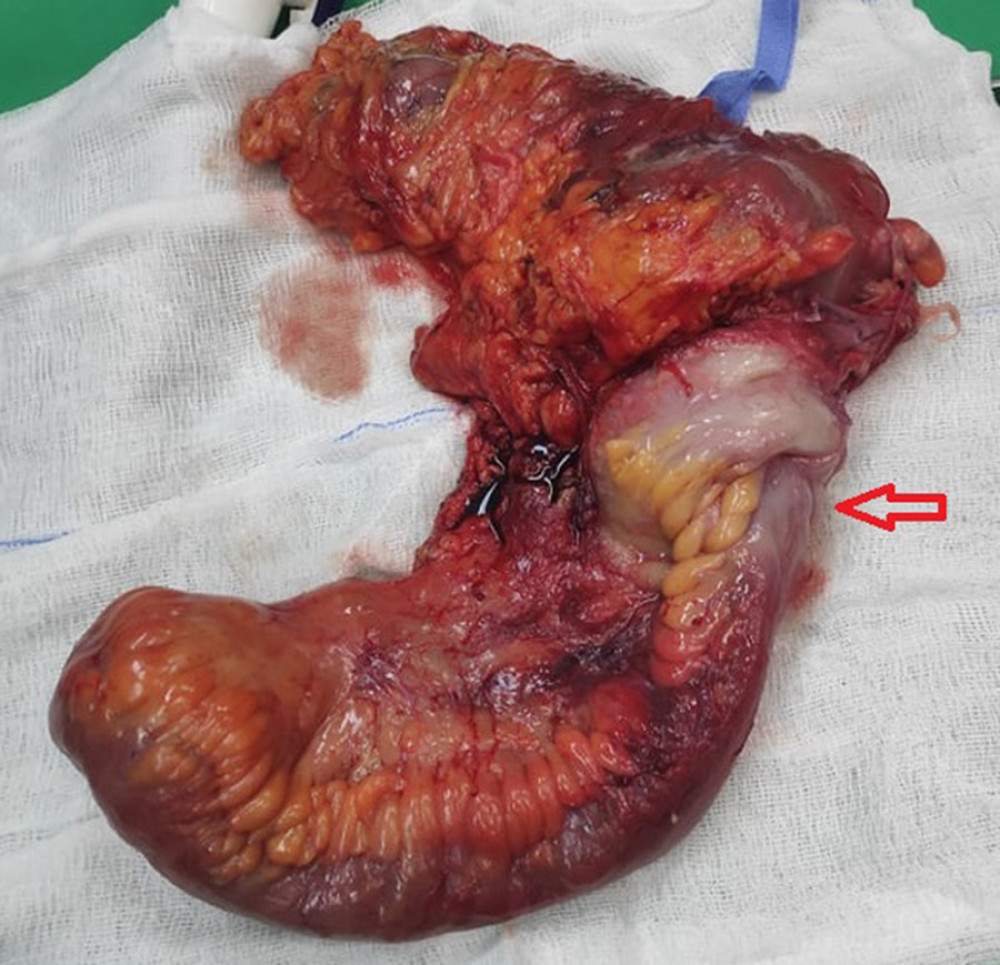 Image of the surgical specimen: The red arrow shows the point of invagination. (Image processed with MS Paint, edition 6.1, 2009, Microsoft Corporation, Redmond, Washington, USA).