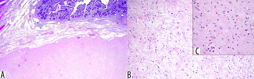 Microscopic images of the polyps (All the images were processed with Adobe Photoshop CS3, Adobe Inc, San Jose, California, USA): (A) Submucosal mesenchymal lesion (hematoxylin and eosin, 20×). (B) Hypocellular neoplasm composed of spindle and stellate cells embedded in edematous stroma with admixed eosinophils and lymphocytes (hematoxylin and eosin, 40×). (C) Hypocellular neoplasm composed of spindle and stellate cells embedded in edematous stroma with admixed eosinophils and lymphocytes (hematoxylin and eosin, 100×).