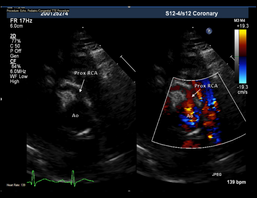 Parasternal short axis view on transthoracic echocardiogram showing ectasia of the proximal right coronary artery (RCA) prior to treatment. Ao – aorta.
