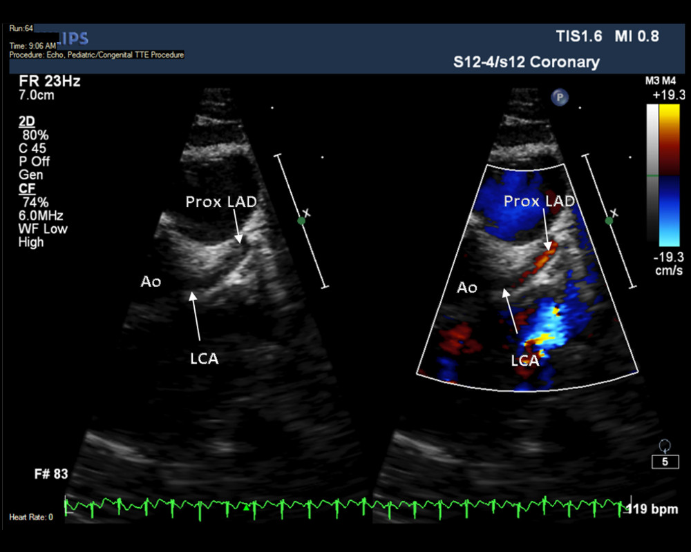 Parasternal short axis view on the most recent transthoracic echocardiogram showing the left main coronary (LCA) and the proximal left anterior descending (LAD) arteries. Ao – aorta.