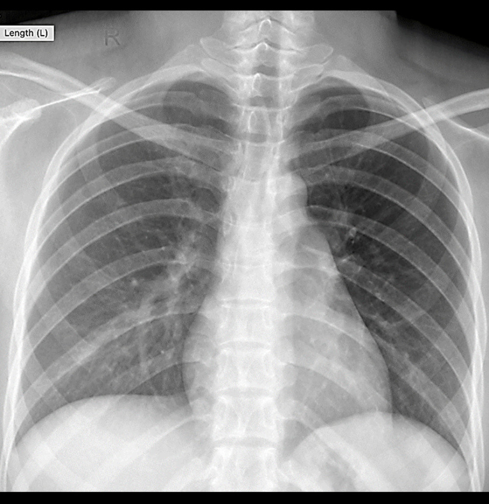 Chest X-ray showing a normal appearance.