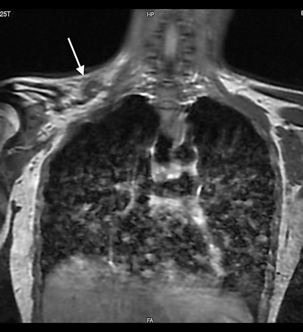 Cervical thoracic magnetic resonance imaging. On a T1-weighted coronal image, right supraclavicular lymph nodes were visible (arrow). Note the fatty stranding around the lymph node, which indicates an inflammatory reaction in that area.