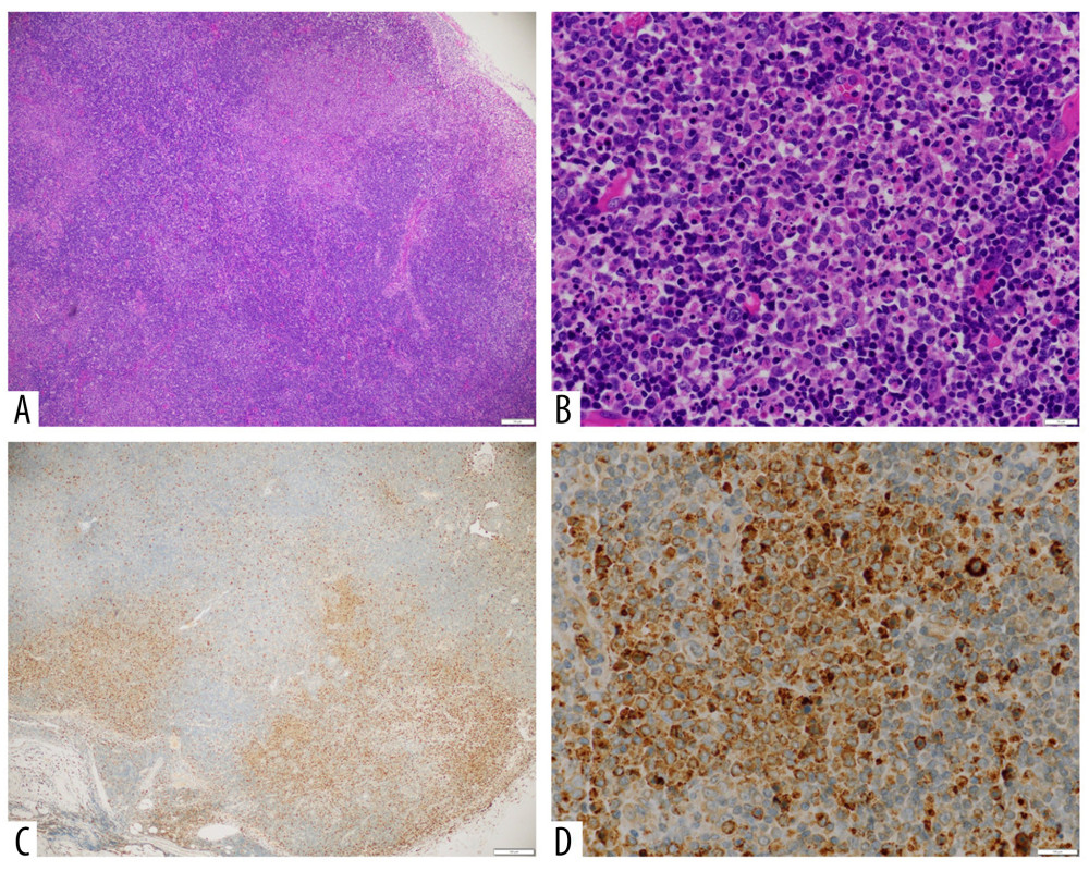 Microscopic view of the affected lymph node showing paracortical, fairly well-circumscribed necrotic lesions (A) with starry sky appearance, karyorrhexis, and phagocytic cells and plasmacytoid monocytes and (B) no neutrophils. Paracortical necrotic lesions were indicated by the expression of CD68 seen in the phagocytic cells at (C) low- and (D) high-power magnification.