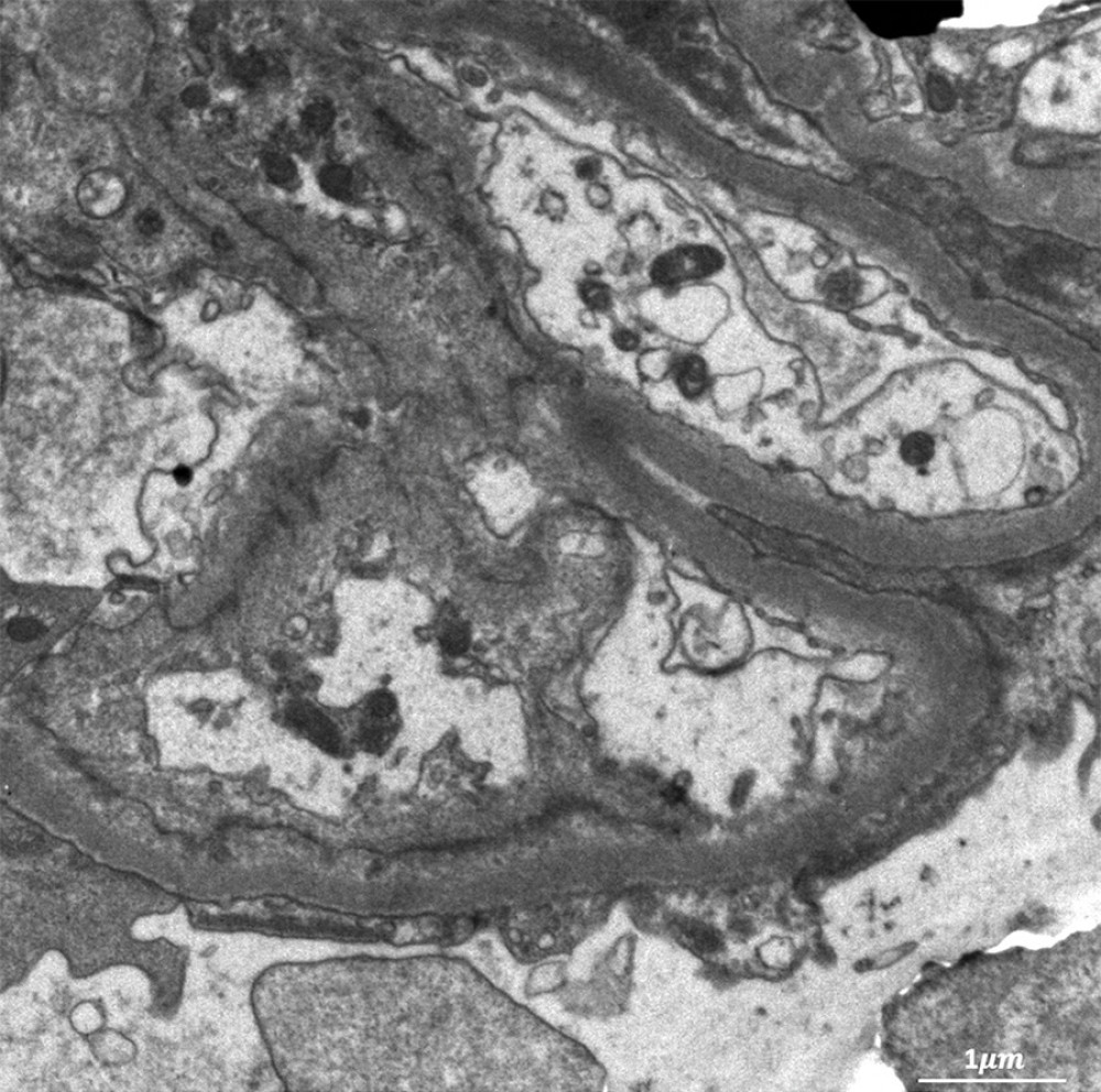 Electron microscopy of kidney tissue. Electron microscopy shows diffuse effacement of foot processes of podocytes, with normal mesangial cellularity and matrix, and normal thickness of the glomerular basement membrane.