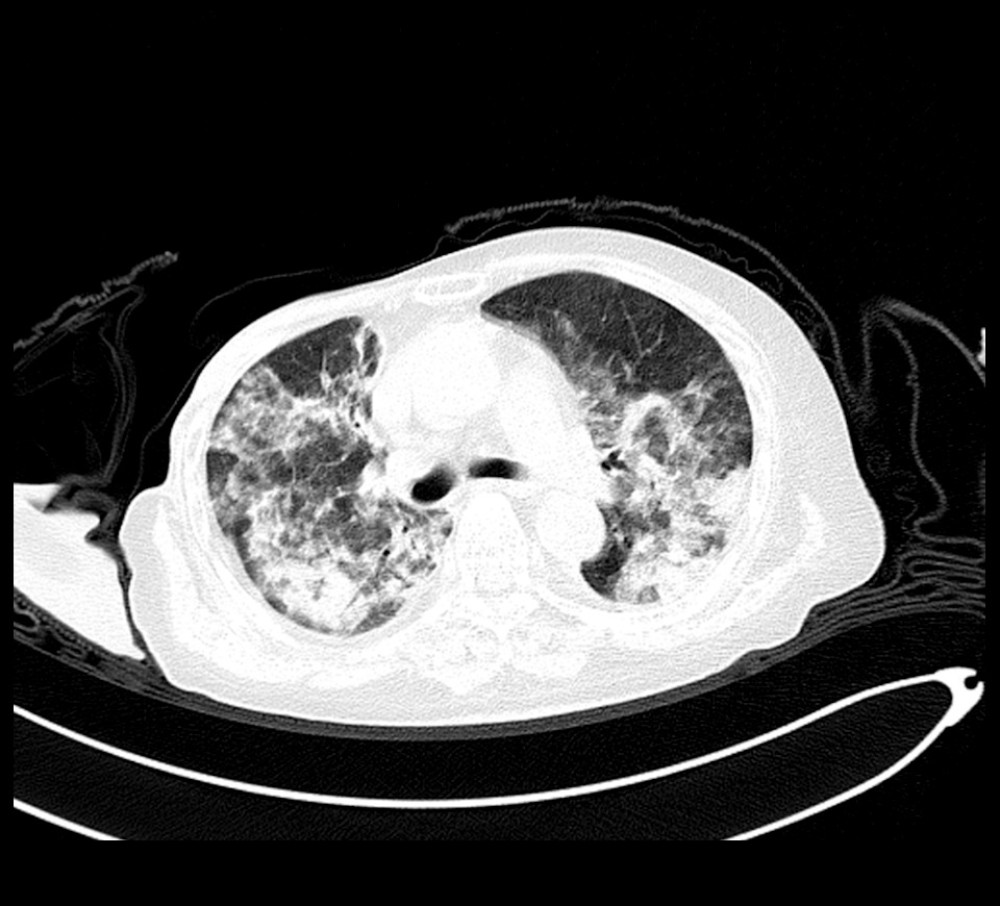 CT scan of the chest obtained at the second admission. CT scans of the chest at the second admission, show bilateral patchy areas of ground-glass opacity with crazy paving appearance and bilateral pleural effusion.