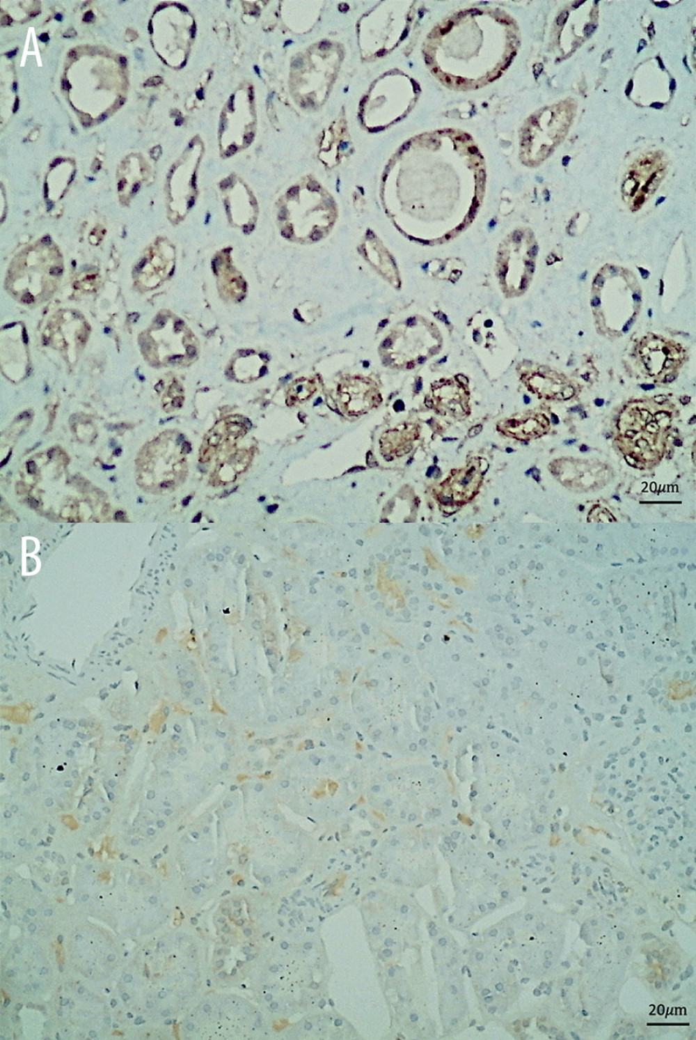 Immunohistochemical staining of CMV in (A) renal tubules of the patient compared with (B) control tissue from the kidney of a normal person shows CMV positivity in the tubules of the patients.