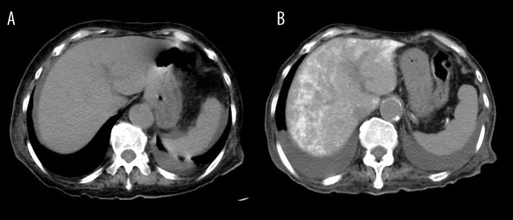 (A) Abdominal computed tomography (CT) scan on day 45. There is no calcification in the liver. (B) Abdominal CT scan on day 140. Diffuse liver calcification is observed in the liver, and small patchy aortic calcification is similarly observed in her aorta.