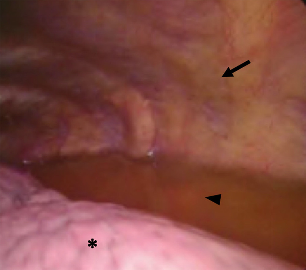 Normal-appearing parietal pleura (arrow) lining the anterior chest wall with serous effusion (arrowhead) and atelectatic left lung (*).