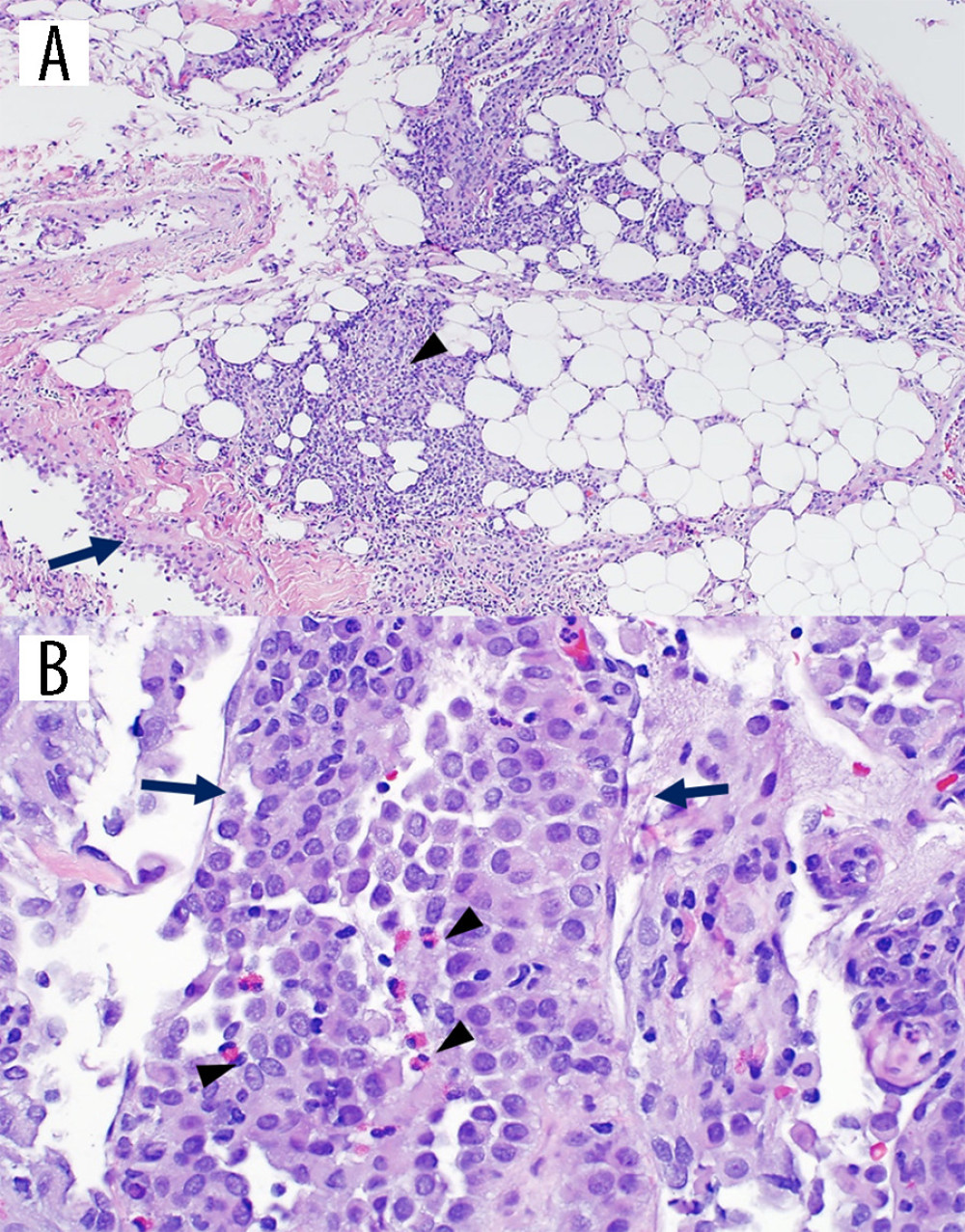 (A) H&E stain of parietal pleural biopsy showing lymphoid infiltration (arrowhead) and reactive mesothelial hyperplasia (arrow) consistent with chronic pleuritis (100×). (B) H&E stain of parietal pleural biopsy showing mesothelial hyperplasia (arrows) with eosinophilic infiltrate (arrowheads) (400×).