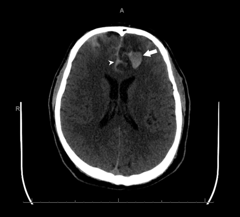 Non-contrast CT brain, axial section at the level of the lateral ventricles, showing intracerebral hemorrhage (arrow) and subarachnoid hemorrhage (arrowhead).