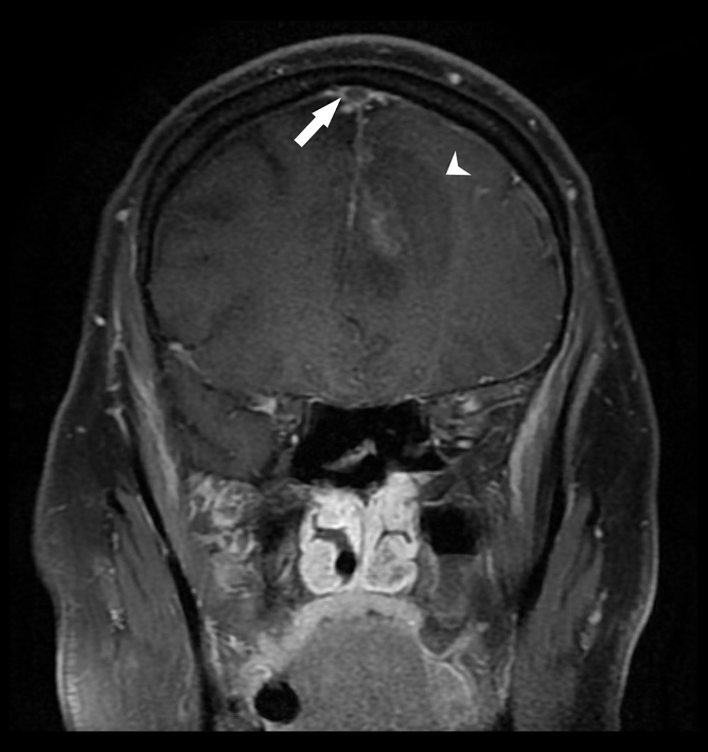 T1-weighted MRI coronal section showing filling defect in the superior sagittal sinus (arrow) with isointense signal of intracerebral hemorrhage (arrowhead) in the left frontal lobe.