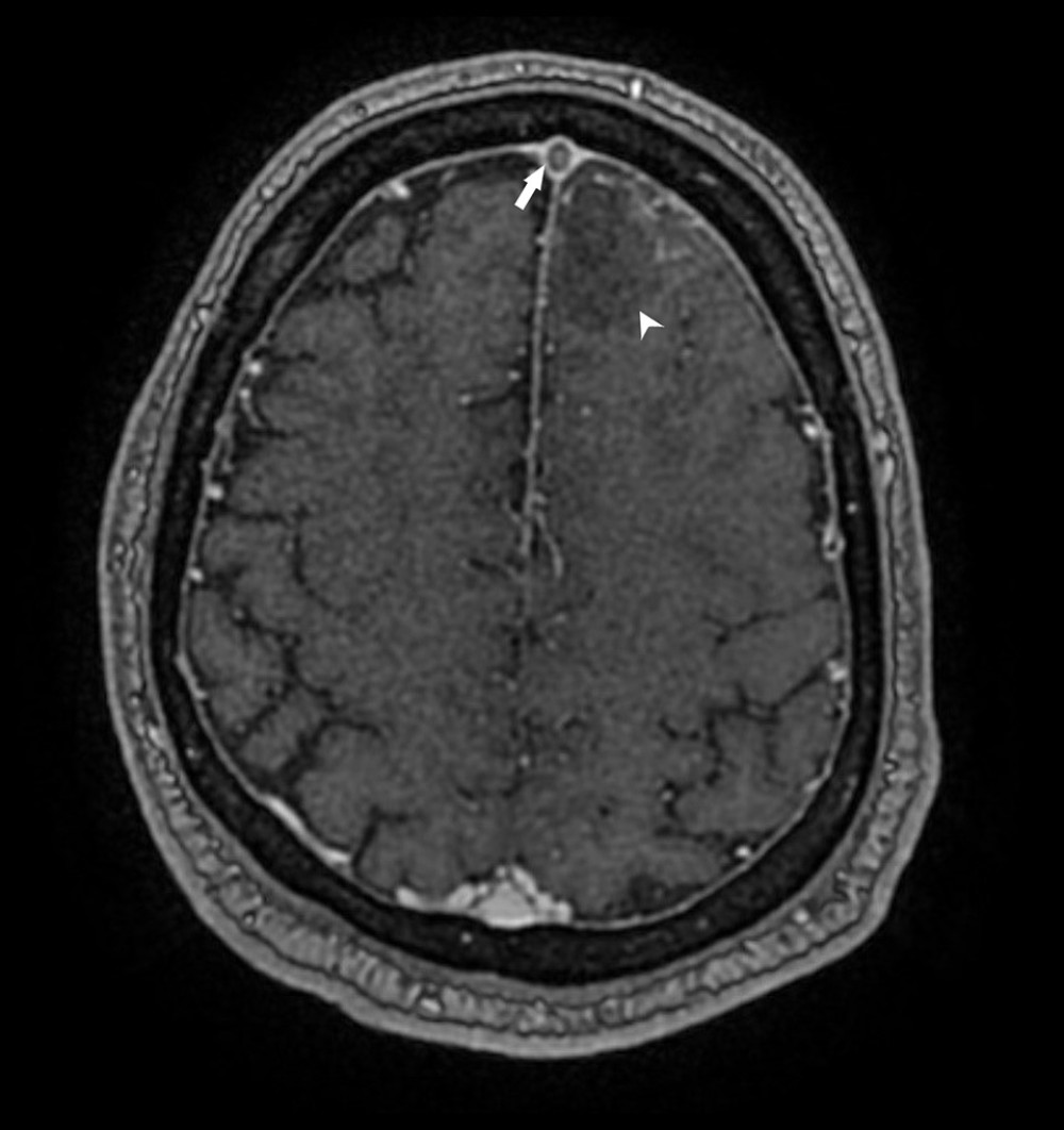 T1-weighted MRI axial section showing filling defect in the superior sagittal sinus (arrow) with intracerebral hemorrhage (arrowhead) in the adjacent front frontal lobe.