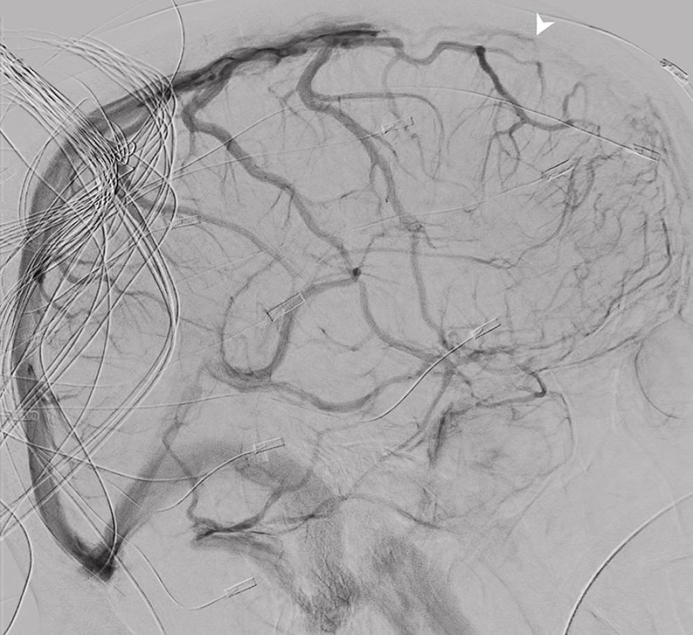 Diagnostic cerebral arteriogram shows absence of flow within the anterior 1/2 of the superior sagittal sinus (arrowhead).