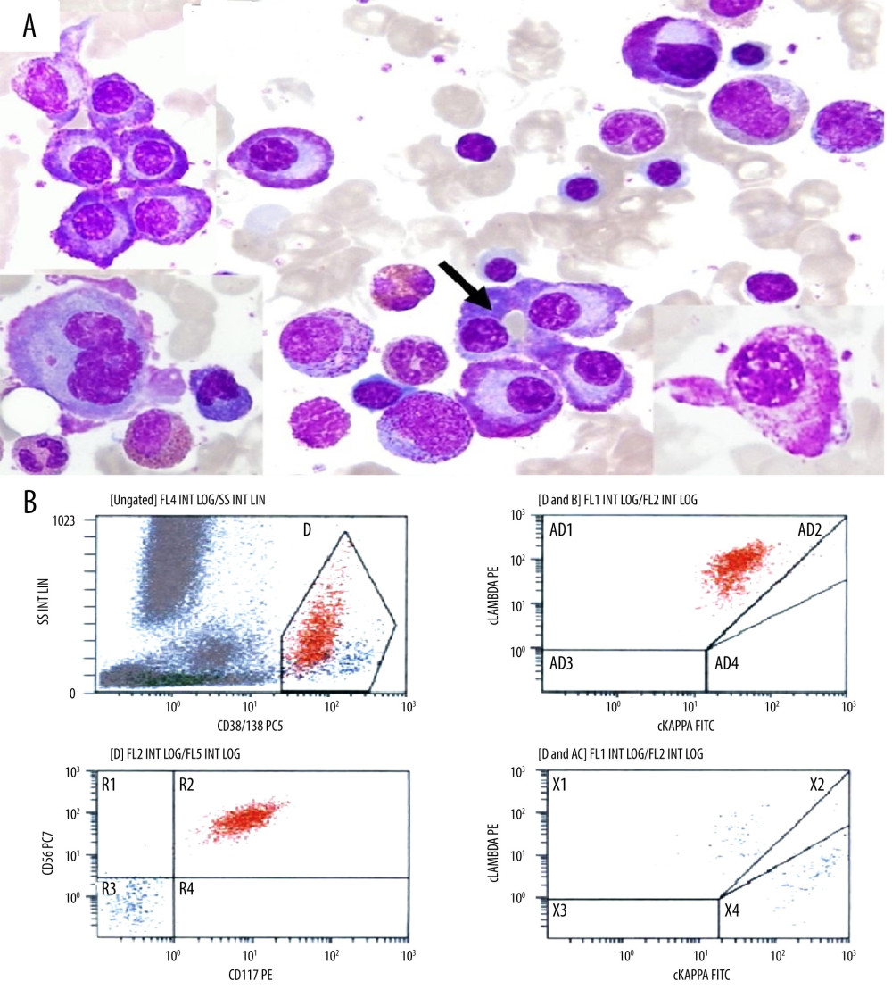 (A) BM aspirate smear (Wright’s stain, 1000×) revealed scattered and clusters of plasma cells, averaged ~20%, morphologically abnormal, substantial number show deep condensed peripheral staining with flame plasma cell-like morphology, many appear granulated (lower right insert) or with immunoglobulin inclusions (Russell bodies, arrowed cell) and a few are binucleated (lower left insert) or have a pleomorphic nucleus. (B) Flow cytometry immunophenotyping on BM aspirate revealed 3% monotypic plasma cells (red population) expressing CD38/CD138 with cytoplasmic lambda light-chain restriction with aberrant CD56 and CD117 expression. Flow cytometry showed <1% residual polytypic plasma cells (blue population).