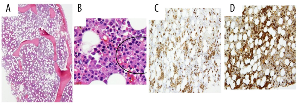 (A) BM biopsy is cellular to mildly hypercellular (H&E, ×40). (B) Higher power (×400) show interstitial and clusters of plasma cells (circled), (C) BM biopsy, CD138 immunohistochemistry highlights scattered and clusters of plasma cells (roughly estimated at 20–30% of core cellularity), (D) lambda light-chain restriction, ×100.
