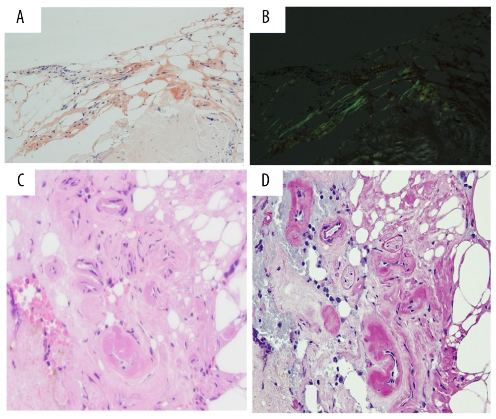 BM biopsy. (A) Amyloid deposits stain pink to red by Congo red by standard light microscopy. (B) The amyloid gives an apple green birefringence under polarized light. (C) (H&E stain), showed a deposition of pink amorphous, waxy-looking deposit, in the thickened blood vessels wall (×500). (D) The deposit is positive for PAS stain (×500).