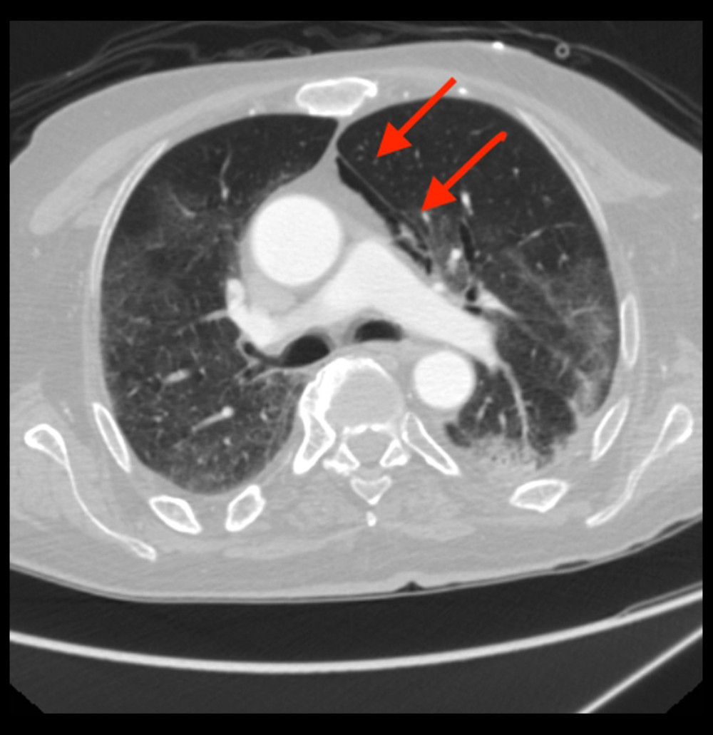 Presence of pneumomediastinum in case 1 located mainly in the left anterior paracardiac area and along the left hilum (maximum thickness 12 mm). Thin flap of pneumothorax on the left in antero-medial arrangement with a maximum thickness of 6 mm.