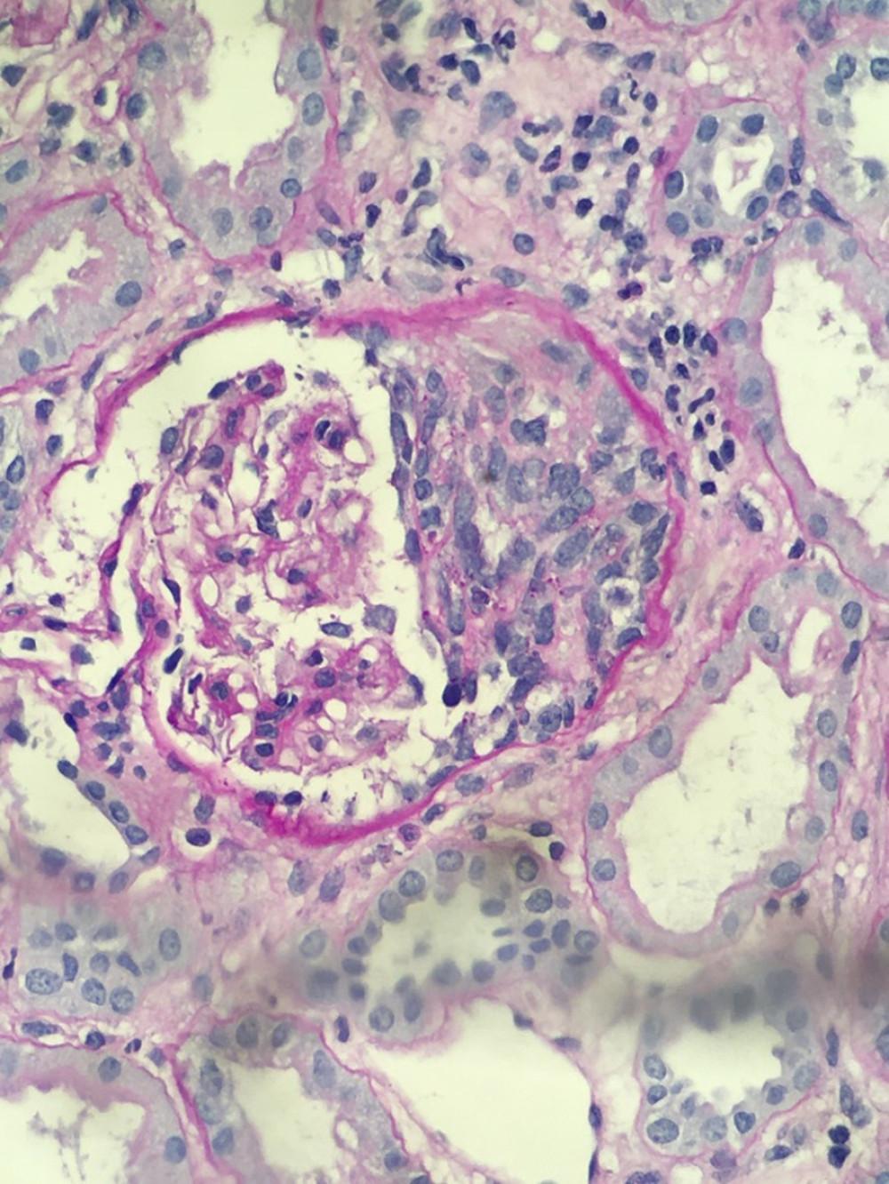 Case 1. Active nephritis shown on kidney biopsy. Native kidney biopsy showing the presence of crescent in an affected glomerulus (magnified ×10, high-power field, stained with periodic acid-Schiff). In a total of 20 glomeruli sampled, there were 8 fibrocellular crescents, 4 of which had segmental fibrinoid necrosis and segmental sclerosis (not shown).