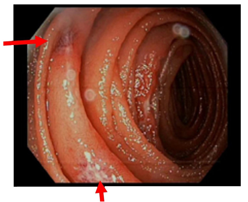 Case 2. Duodenum ulcers. Macroscopic appearance of the duodenum on endoscopy showing non-ulcerative vasculitic lesions (indicated by arrows).