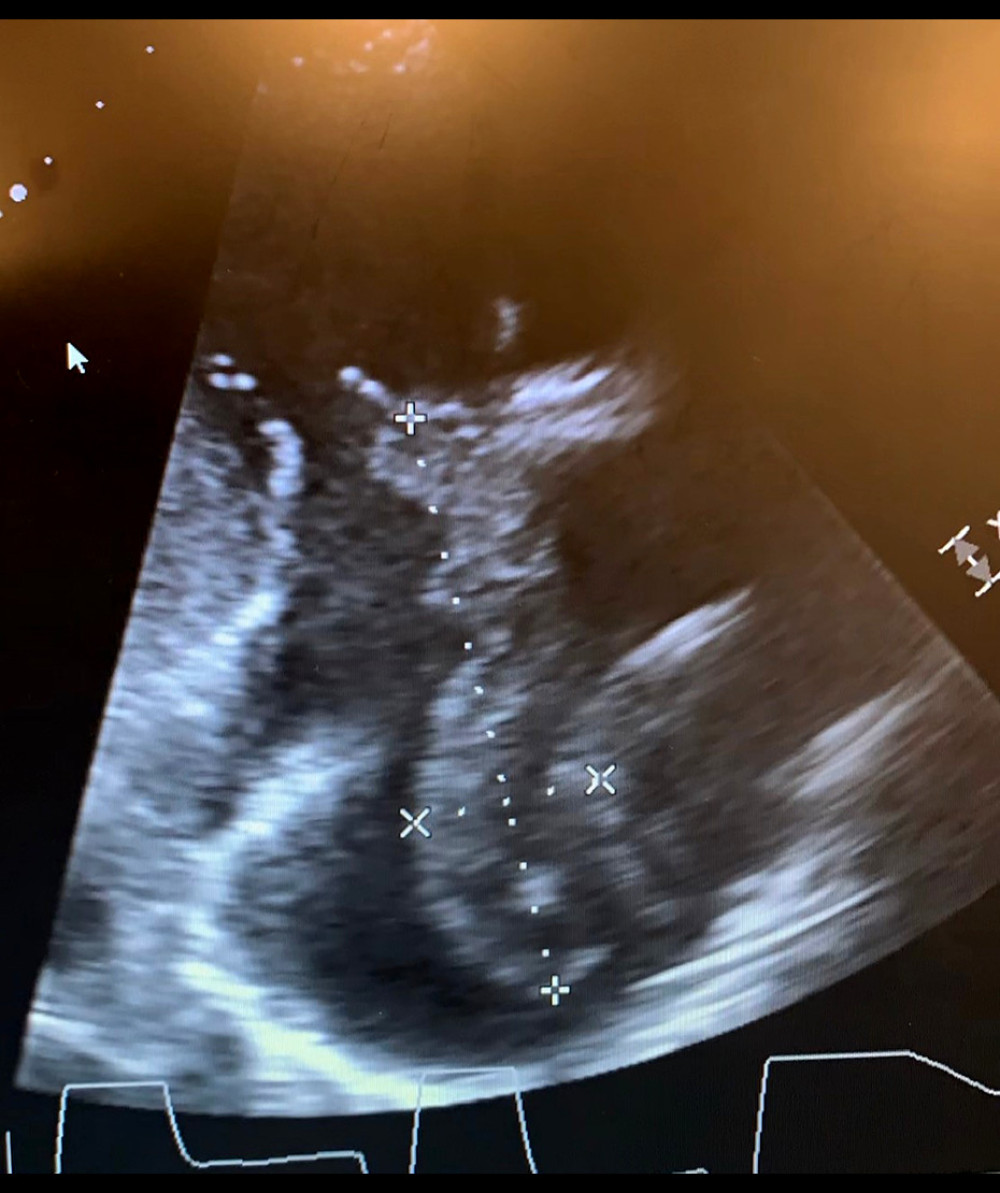 Case 1: Cardiac echography showing large right atrial thrombi.