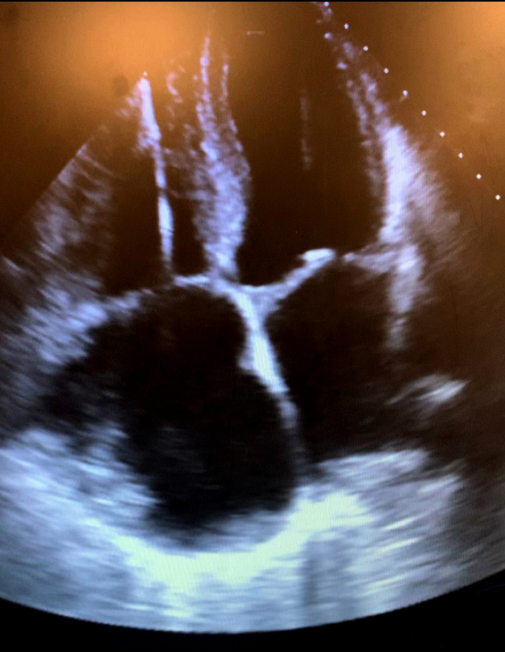 Case 1: Cardiac echography showing resolution of right atrial thrombi after thrombolytic therapy.