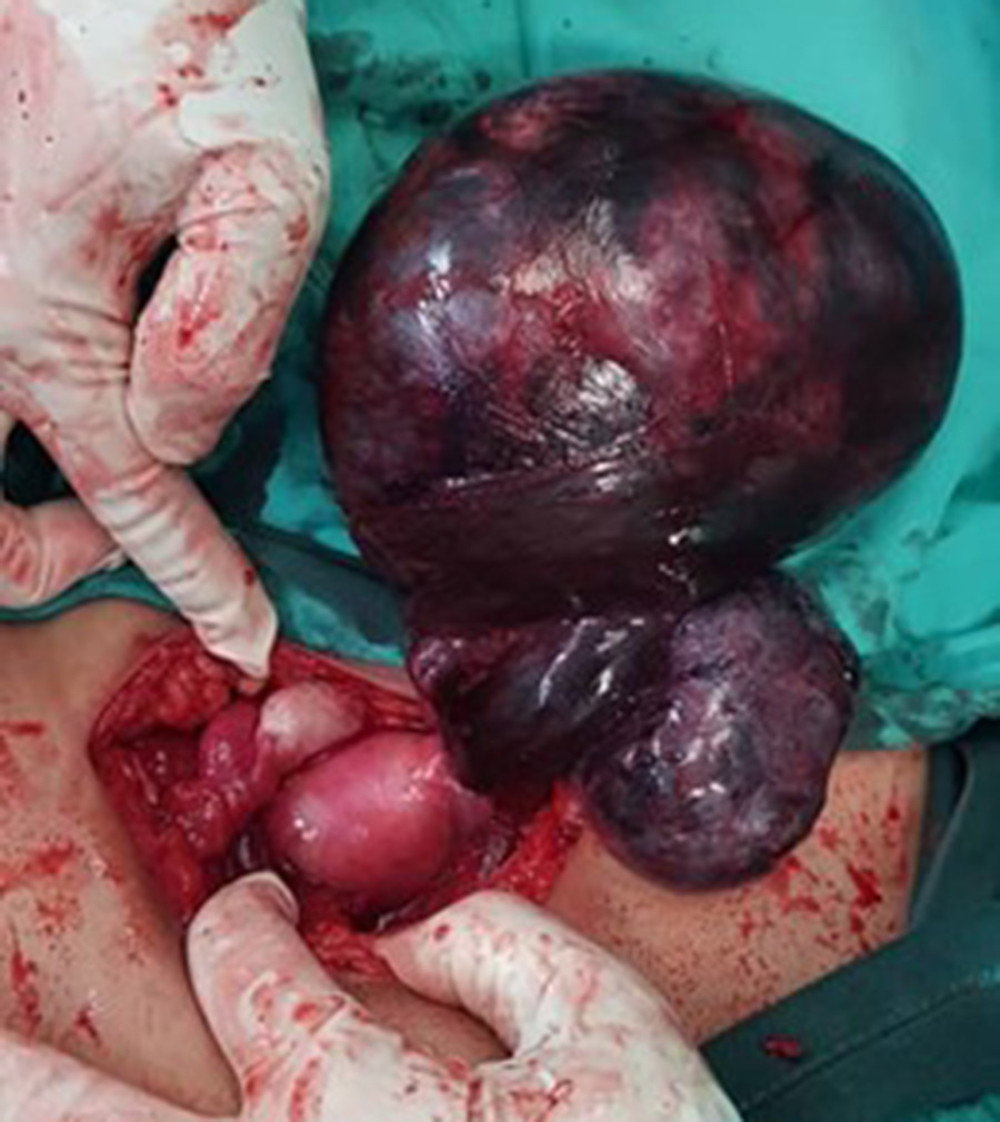 Gangrenous-looking left ovary and fallopian tube.