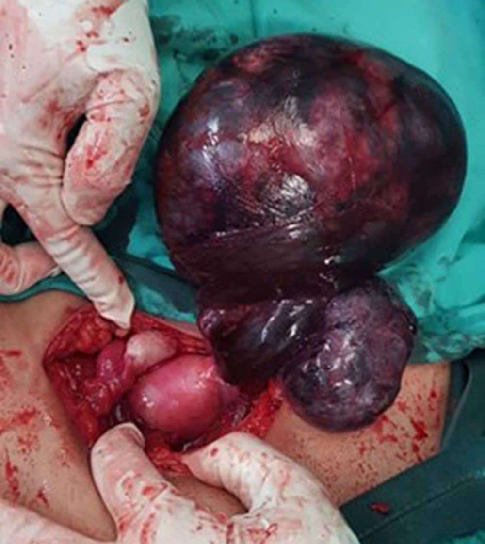 American Journal of Case Reports  A Case of Twisted Ovarian Cyst in a  Young Patient and Review of the Literature - Article abstract #933438