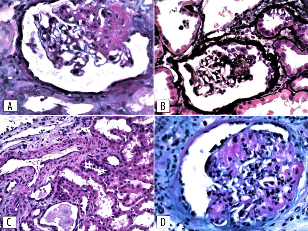 First kidney biopsy: (A) segmental sclerosis and hyalinosis of the glomerular capillary tufts (PAS staining, ×200); (B) a small focus of collapsed capillary loops and overlying slight epithelial hypertrophy and hyperplasia in the Bowman space of one glomerulus (Jones’ methenamine-silver staining, ×200); (C) interstitial edema, severe degenerative changes of tubular epithelium and tubular microcysts, mild to moderate interstitial inflammation, composed of mononuclear leukocytes, some proximal tubular epithelial cells contained intracytoplasmic protein droplets positive for periodic-acid-Schiff (PAS staining, ×200). (D) The re-biopsy showed segmental sclerosis and hyalinosis of the glomerular capillary tuft, glomerular epithelial cells contained PAS – positive droplets (PAS staining, ×200).