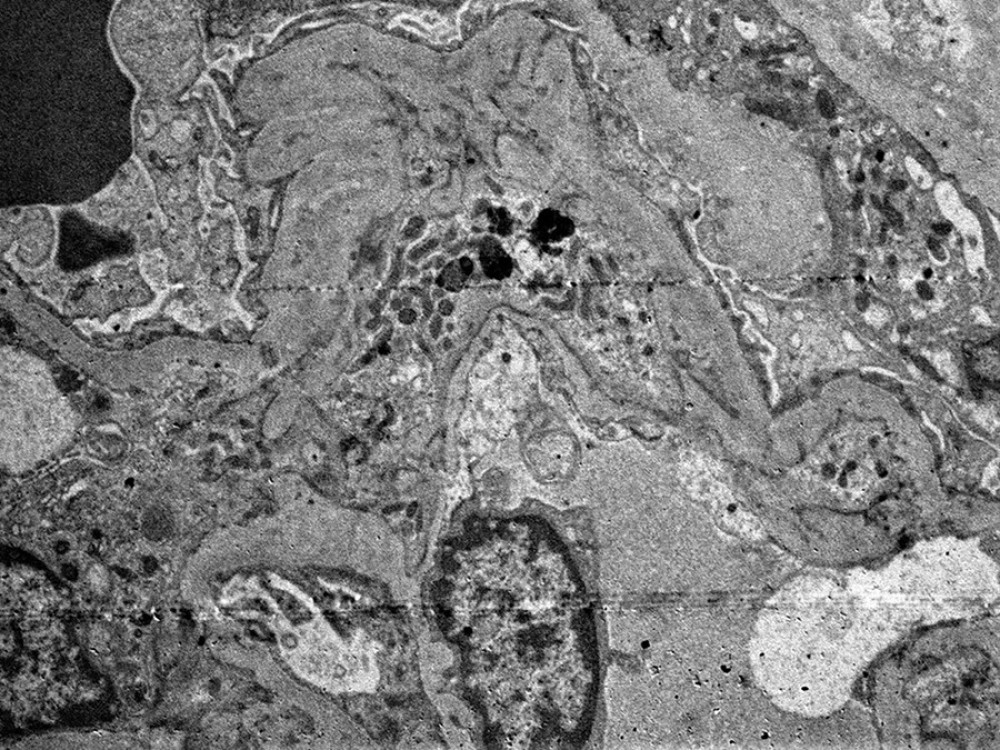 The re-biopsy, ultrastructural examination revealed focal thickening of the glomerular basement membrane, and foot process effacement. No immune-type electron-dense deposits were identified (original magnification ×4000).