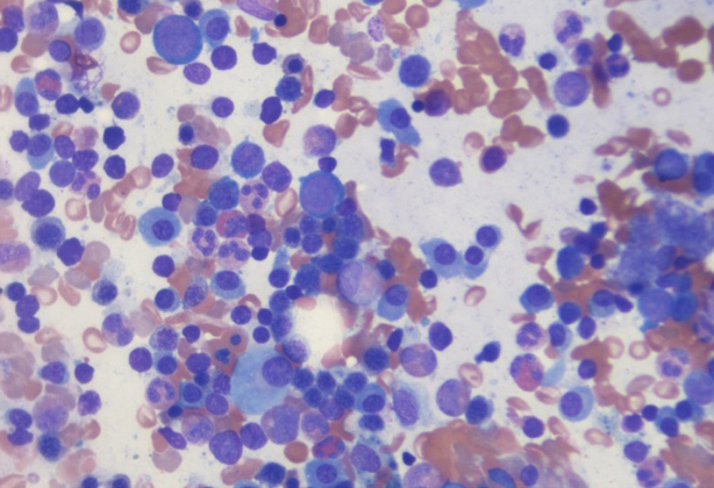 Bone marrow smear, Wright-Giemsa 40×: numerous atypical plasma cells with multi-nucleation and prominent nucleoli.