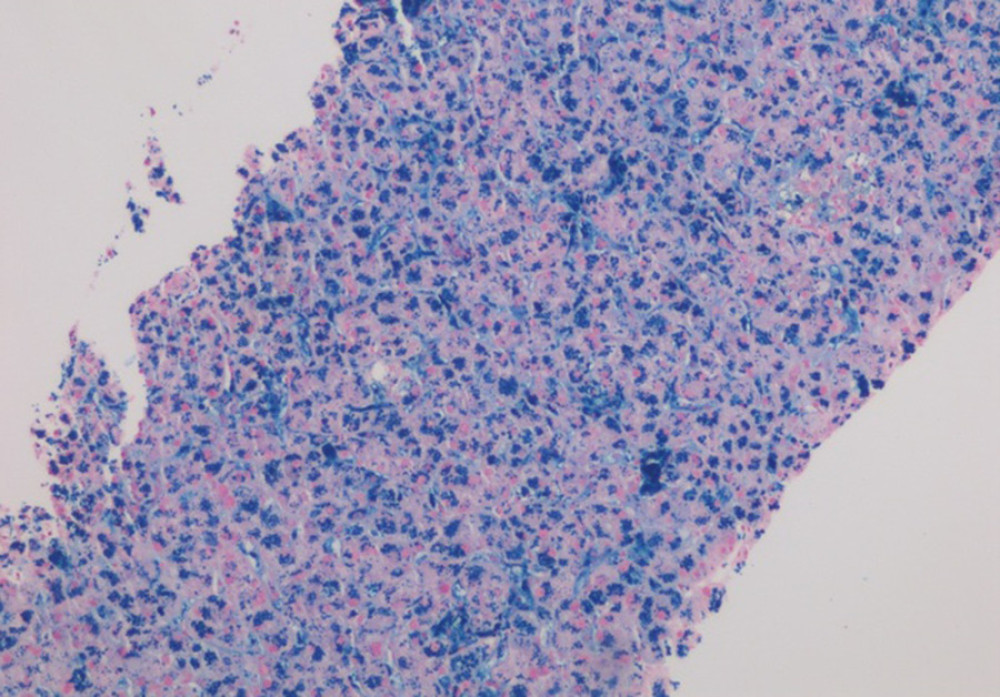 Liver biopsy, Prussian Blue 10×: Iron stain highlights overload of iron deposits on Kupfer cells.