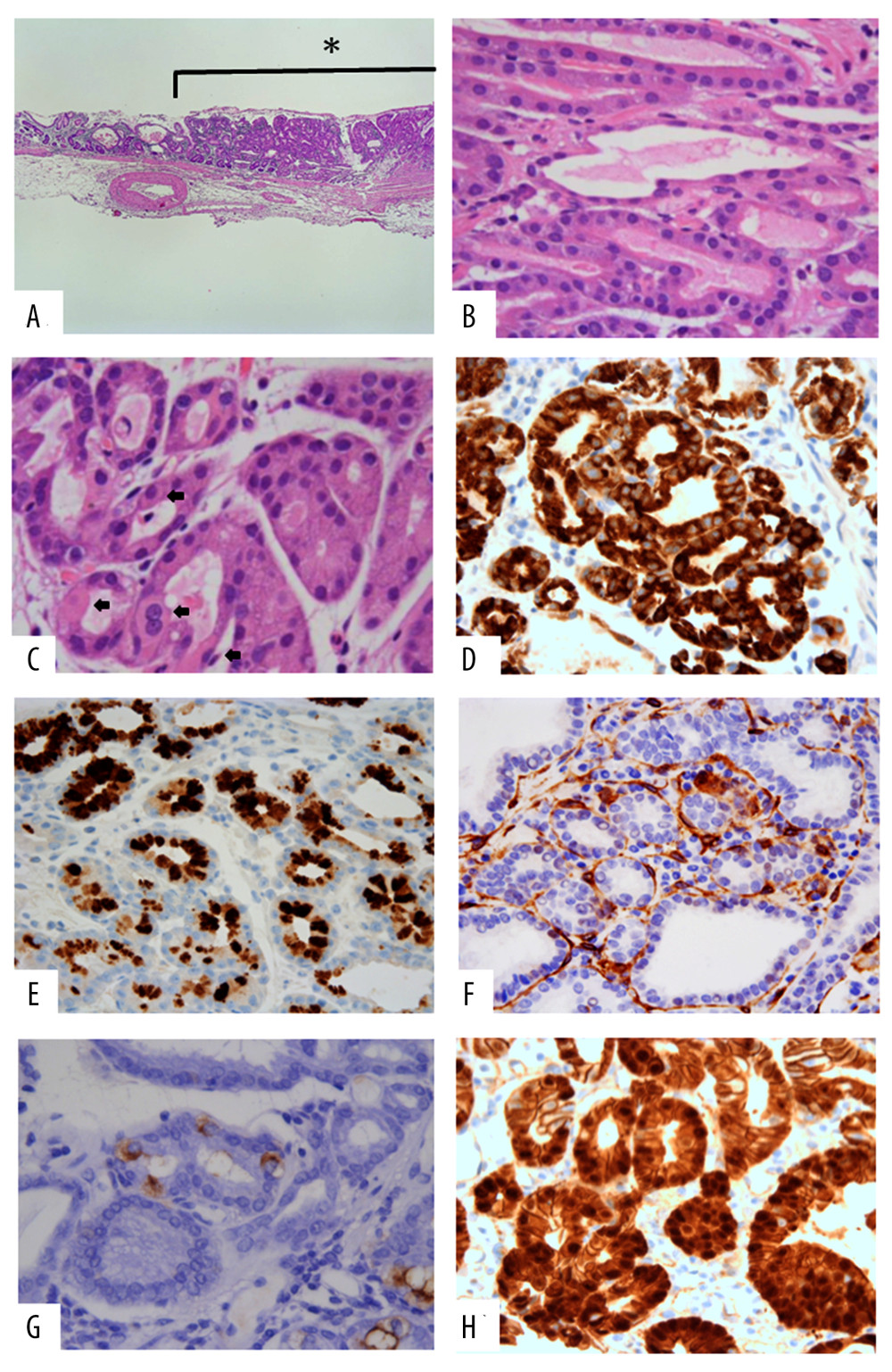 At low magnification, a gastric adenocarcinoma of the fundic gland type (GAFG) is located in the mucosa (A). The tumor consisted of clustered tumor cells resembling chief cells and cystic glands (B). At high magnification, it is clear that the tumor contains chief cells and parietal cells ➙ (C). Immunohistochemically, the tumors are positive for MUC6 and pepsinogen-I in chief cells, H+/K+ ATPase and PDGFRα in parietal cells (D–G) and are focally strongly positive for β-catenin (H).