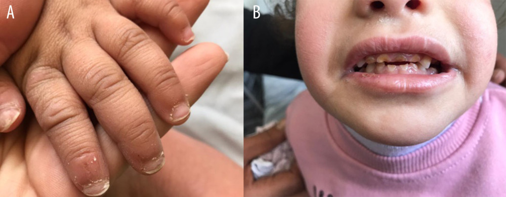 Evidence of self-inflicted injury. (A) Damaged fingernails. (B) Dentition eruption.