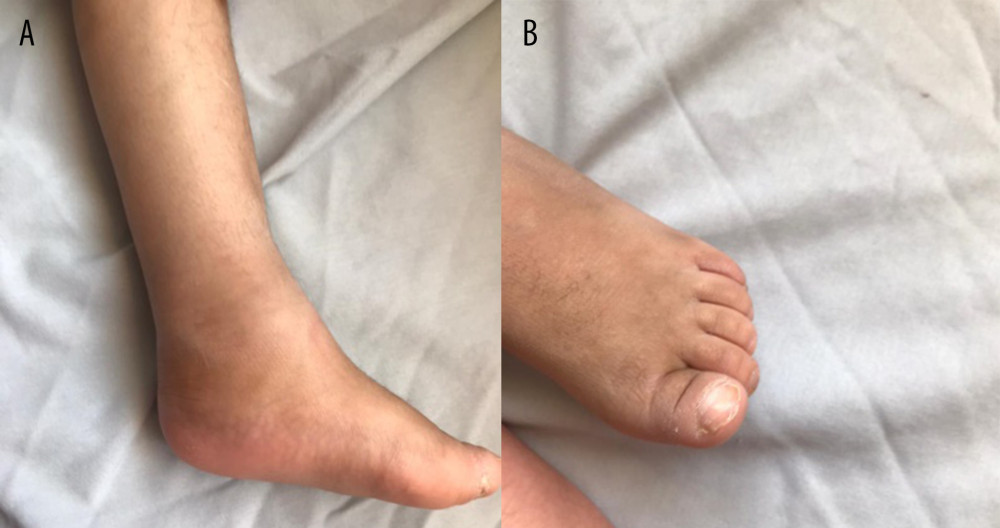 Healed wound 12 weeks after open reduction and k wire for open dislocated distal phalanx. (A) Lateral view of big toe. (B) Anterior view of big toe.