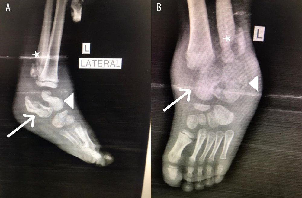 Left foot X-ray, diffuse osteomyelitis involving the talus (arrow), calcaneus (arrow head), and distal fibula (star). (A) Lateral view X-ray of the left foot. (B) Anterior-posterior view X-ray of the left foot.