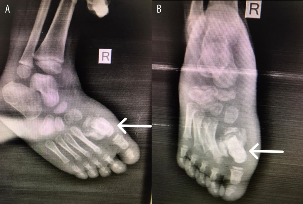 Right foot X-ray, first metatarsal bone fracture, and callous formation (arrow). (A) Lateral view X-ray of the right foot. (B) Anterior-posterior view X-ray of the right foot.