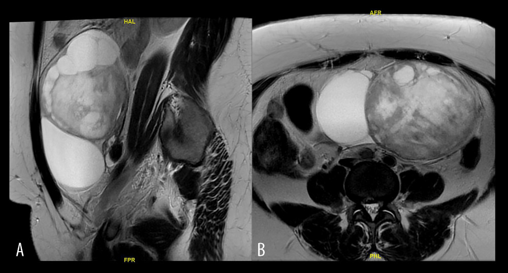 Magnetic resonance imaging of the pelvis with intravenous contrast showing a large complex multiloculated left adnexal mass. (A) A sagittal T2-weighted image and (B) an axial T2-weighted image.