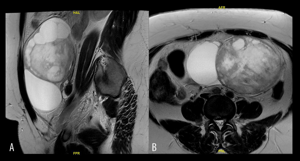 American Journal of Case Reports  A 46-Year-Old Woman with Primary  Infertility and a Diagnosis of Microcystic Stromal Tumor of the Ovary  Confirmed by Histology and Gene Sequencing: A Case Report and