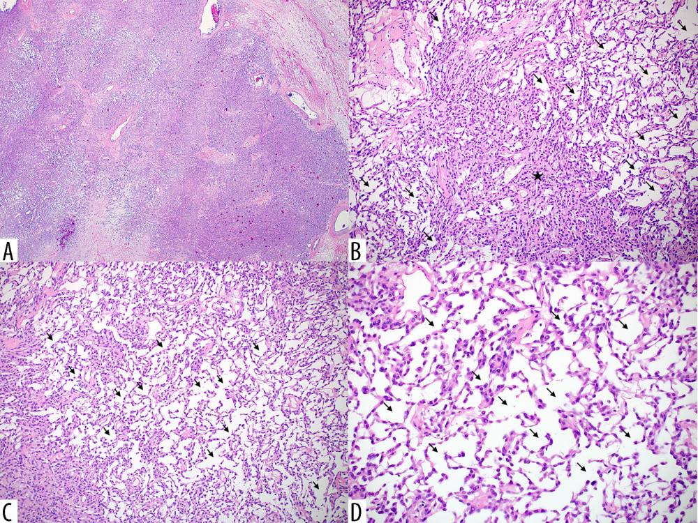 Microcystic stromal tumor. (A) A low-power photomicrograph showing the tumor’s lobular architecture with scattered fibrous plaques (hematoxylin and eosin stain, ×20). (B) The tumor shows a more cellular area in the center (star) surrounded by microcysts (arrows) (hematoxylin and eosin stain, ×100). (C) The distinctive anastomosing channels or microcysts (arrows) of this tumor are noted in this image (hematoxylin and eosin stain, ×100). (D) Tumor cells forming microcysts (arrows) and have a finely granular pale eosinophilic cytoplasm and round nuclei (hematoxylin and eosin stain, ×200).